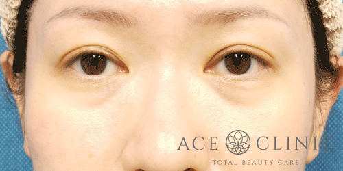 経結膜ハムラ法症例