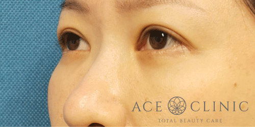 経結膜ハムラ法症例