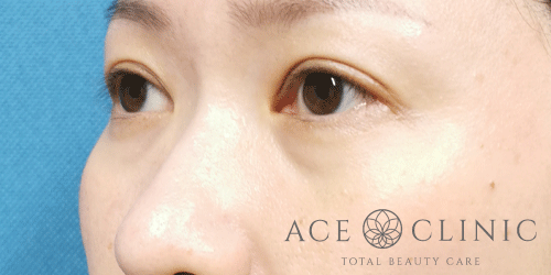 経結膜ハムラ法症例