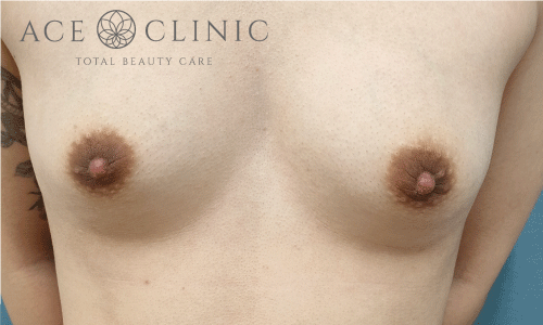 乳頭縮小|症例38|27歳女性|術後3ヶ月|エースクリニック大阪梅田HEPナビオ院