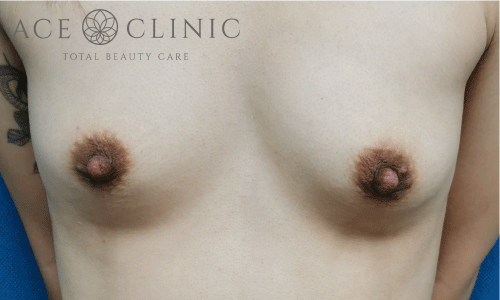 乳頭縮小|症例38|27歳女性|術前|エースクリニック大阪梅田HEPナビオ院