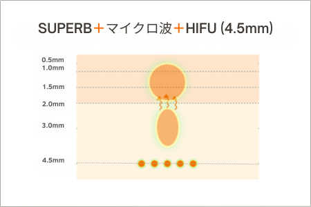SUPERB+マイクロ波+HIFU(4.5mm)の熱の入り方のイメージ