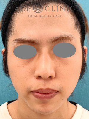 あごプロテーゼ挿入術|症例5|術後 正面|エースクリニック大阪梅田HEPナビオ院