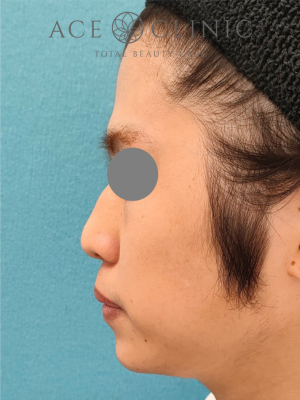 あごプロテーゼ挿入術｜症例5｜術後　左横｜エースクリニック大阪梅田HEPナビオ院