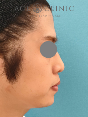 あごプロテーゼ挿入術｜症例5｜術後　右横｜エースクリニック大阪梅田HEPナビオ院