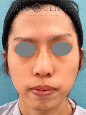 あごプロテーゼ挿入術|症例5|術前 正面|エースクリニック大阪梅田HEPナビオ院