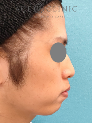 あごプロテーゼ挿入術｜症例5｜術前　右横｜エースクリニック大阪梅田HEPナビオ院