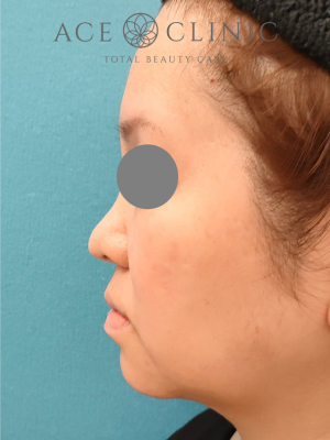 あごプロテーゼ挿入｜症例6｜47歳女性｜術後｜左横｜エースクリニック大阪梅田HEPナビオ院