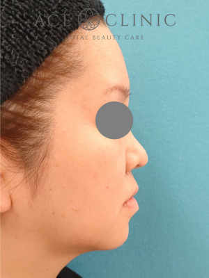 あごプロテーゼ挿入｜症例6｜47歳女性｜術後｜右横｜エースクリニック大阪梅田HEPナビオ院