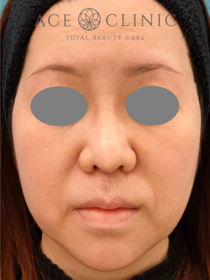 あごプロテーゼ挿入|症例6|47歳女性|術後|正面|エースクリニック大阪梅田HEPナビオ院