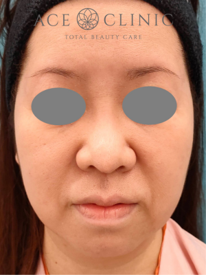 あごプロテーゼ挿入|症例6|47歳女性|術前|正面|エースクリニック大阪梅田HEPナビオ院