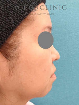 あごプロテーゼ挿入｜症例6｜47歳女性｜術前｜右横｜エースクリニック大阪梅田HEPナビオ院