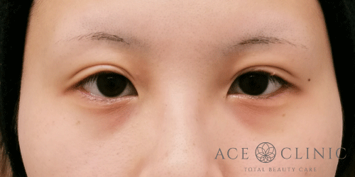 二重埋没法｜症例53｜女性｜術後1ヶ月｜大阪梅田HEPナビオ院