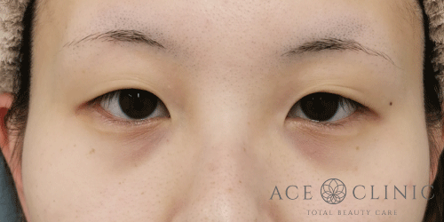 二重埋没法｜症例53｜女性｜術前｜大阪梅田HEPナビオ院