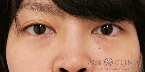 切らないクマ治療｜症例6｜女性｜術後2週間｜大阪梅田HEPナビオ院