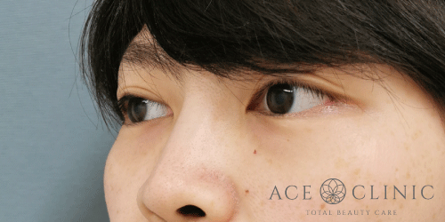 切らないクマ治療｜症例6｜女性｜術後2週間｜大阪梅田HEPナビオ院