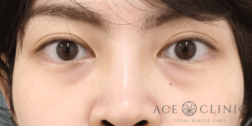 切らないクマ治療｜症例6｜女性｜術前｜大阪梅田HEPナビオ院