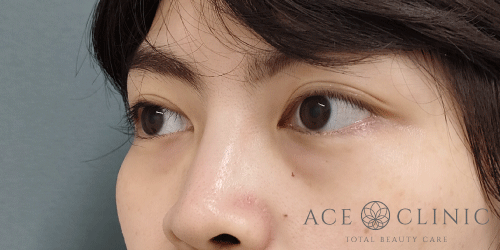 切らないクマ治療｜症例6｜女性｜術前｜大阪梅田HEPナビオ院