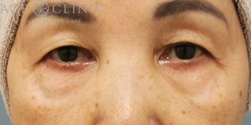 脱脂CRF法|症例34|女性|術後3ヶ月|大阪梅田HEPナビオ院