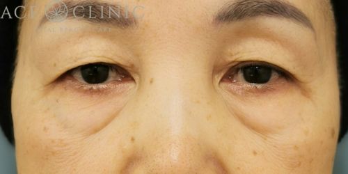 脱脂CRF法|症例34|女性|術前|大阪梅田HEPナビオ院