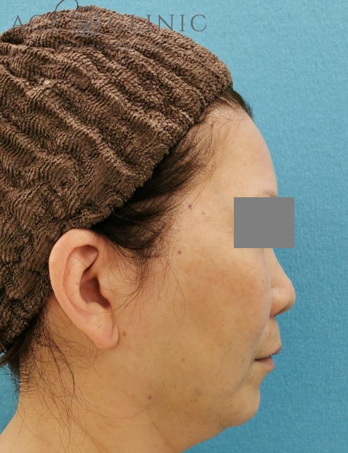 vovリフトプレミアム症例