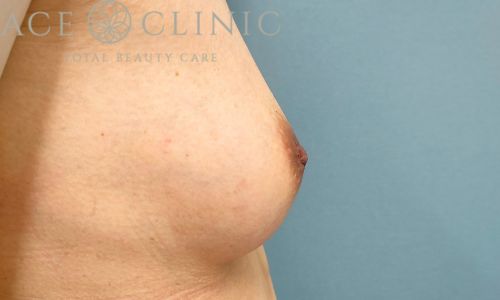 乳頭縮小術|症例40|女性|術後1ヶ月|大阪梅田HEPナビオ院