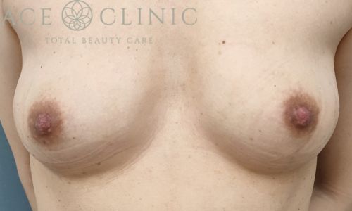 乳頭縮小術｜症例41｜女性｜術後3ヶ月｜大阪梅田HEPナビオ院