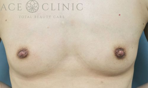 乳頭縮小術｜症例42｜男性｜術後2ヶ月｜大阪梅田HEPナビオ院