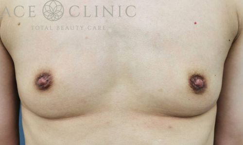 乳頭縮小術｜症例42｜男性｜術前｜大阪梅田HEPナビオ院