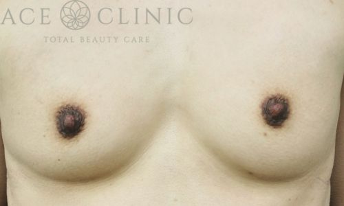乳頭縮小｜症例44｜女性｜術後3ヶ月｜大阪梅田HEPナビオ院