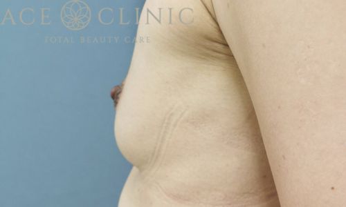 乳頭縮小|症例44|女性|術後3ヶ月|大阪梅田HEPナビオ院