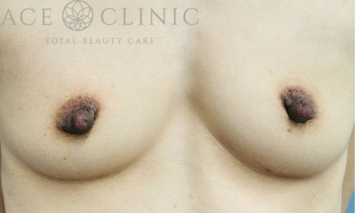 乳頭縮小｜症例44｜女性｜術前｜大阪梅田HEPナビオ院