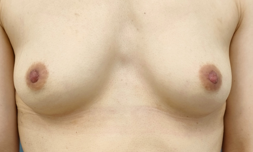 乳頭縮小症例-中山医師