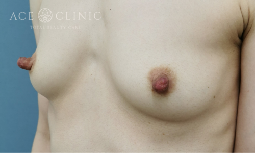 乳頭縮小症例-中山医師