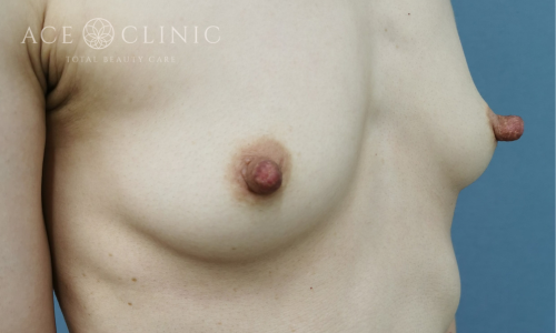 乳頭縮小症例-中山医師