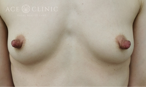 乳頭縮小症例-中山医師