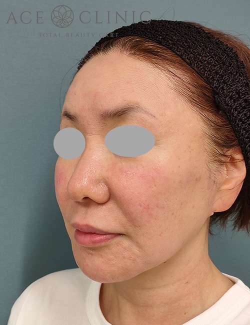 ソフウェーブ症例施術後