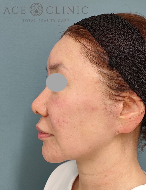 ソフウェーブ症例施術後