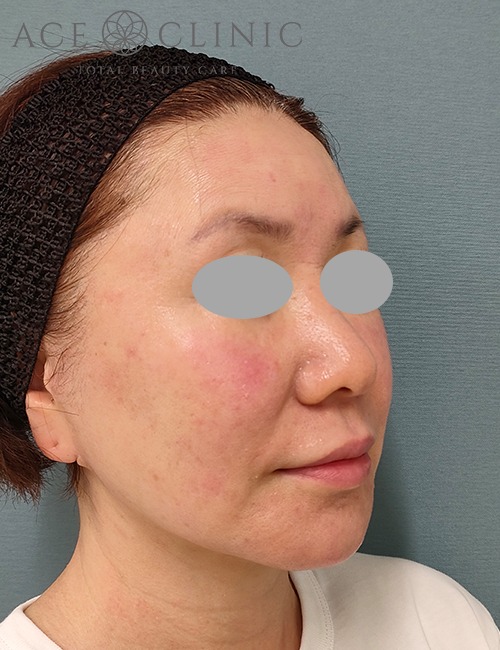 ソフウェーブ症例施術後