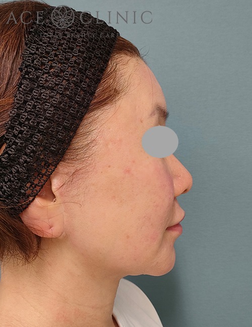 ソフウェーブ症例施術後