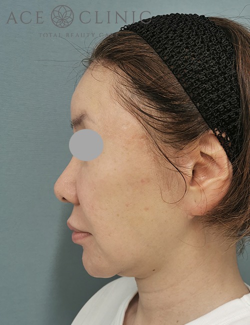 ソフウェーブ症例施術前