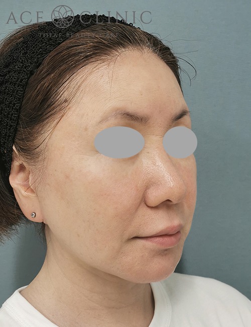 ソフウェーブ症例施術前