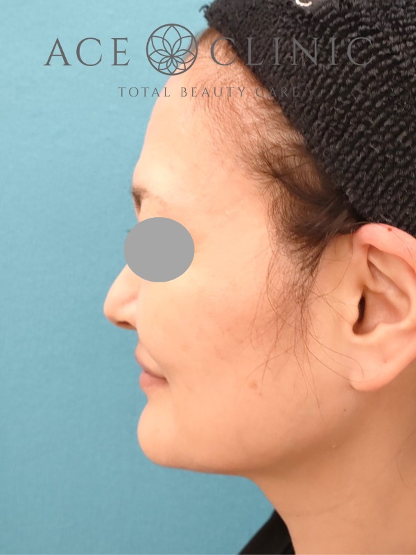 ソフウェーブ症例