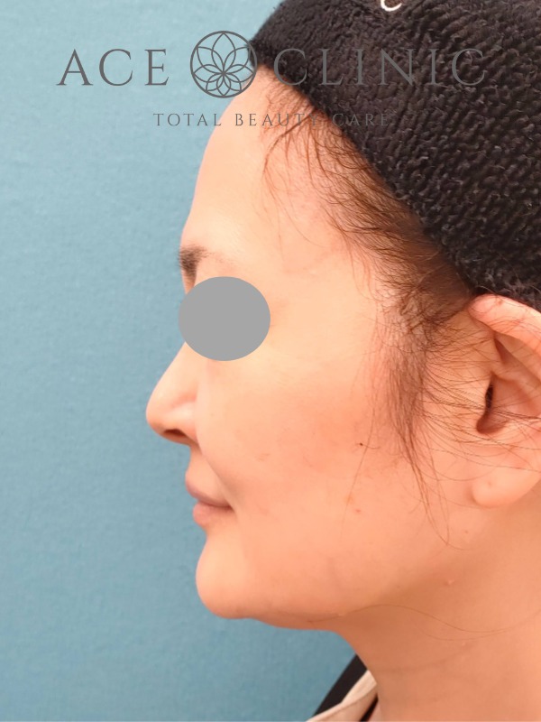 ソフウェーブ症例