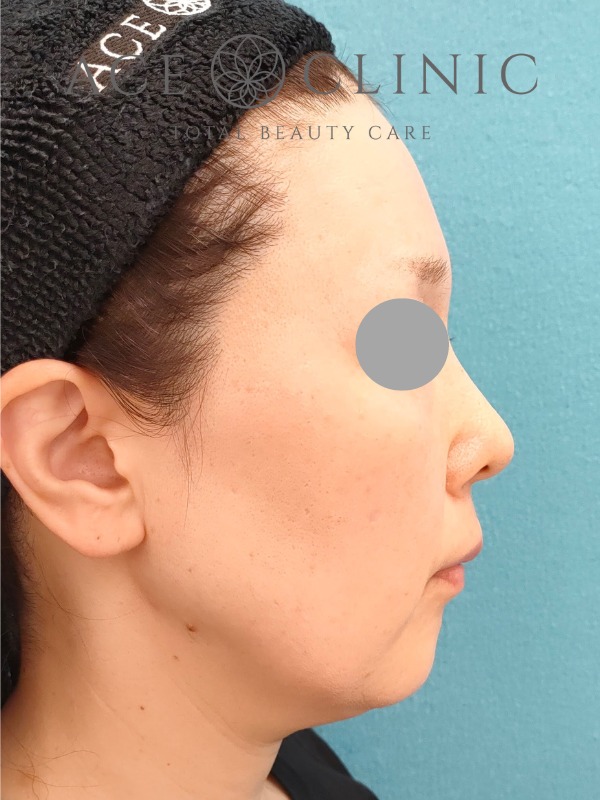 ソフウェーブ症例2