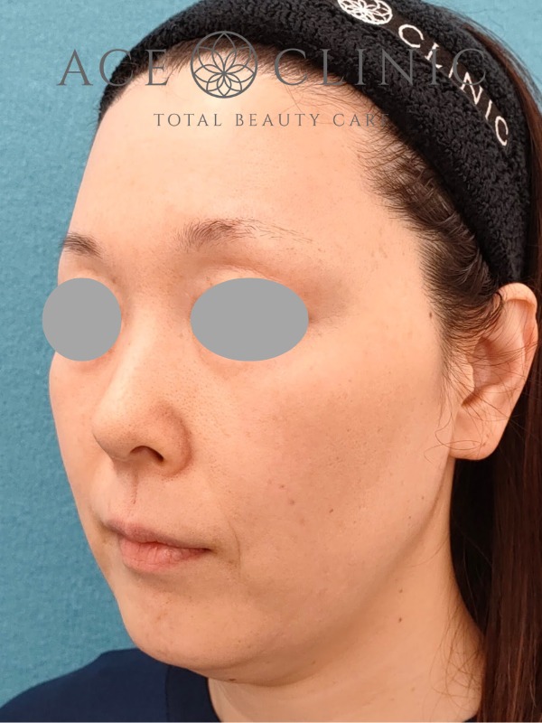 ソフウェーブ症例