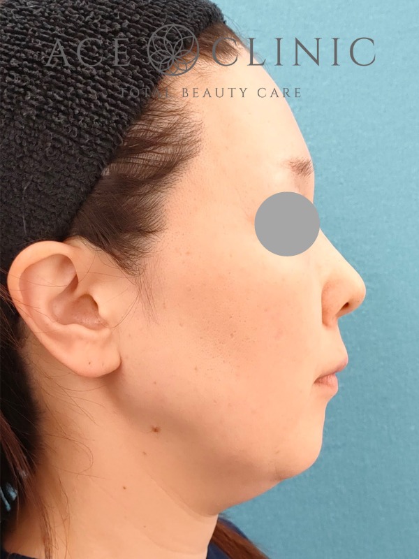 ソフウェーブ症例