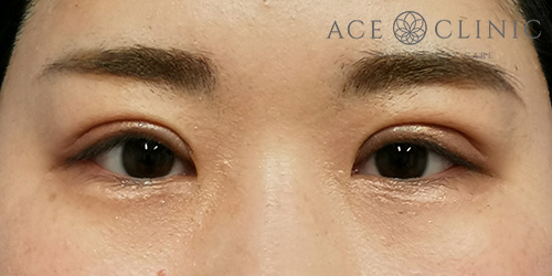 中山医師-眼瞼挙筋前転法