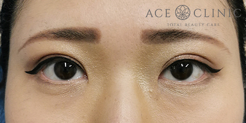 中山医師-眼瞼挙筋前転法症例