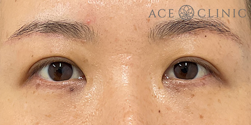 谷院長-眼瞼挙筋前転法症例